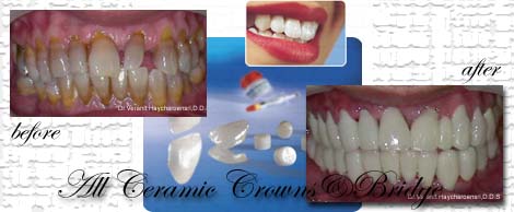 All ceramic crowns&bridges:Phuket Dentist,Thailand
